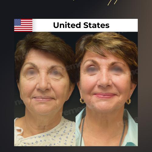 Photos Avant / Après 6